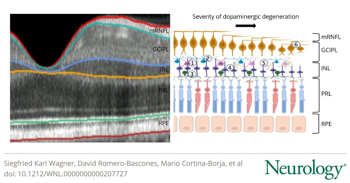 GreenJournal's tweet photo. This study found people with #Parkinson disease have reduced thickness of the INL &amp; GCIPL of the retina. Involvement of these layers several years before clinical presentation highlight a potential role for retinal imaging for at-risk stratification of PD: https://t.co/TNXm2ILPx0 https://t.co/h4uV8WaHrH