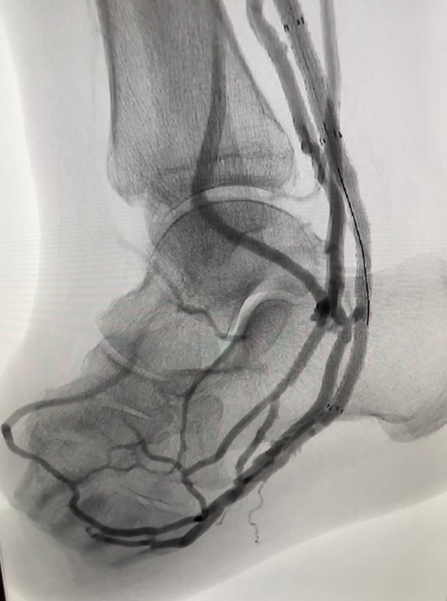 DrPatGeraghty's tweet photo. Two DVA patients WALKED into clinic for one year follow up. First pt: conduit patent with flow of 300-500 ml/min, open TMA remains fully healed. Second pt: conduit failed at 6 months, but openTMA remains fully healed and symptom free. We are primed for PROMISE III @WashUVascular https://t.co/mfLiahUsdn