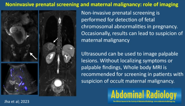 Graphical abstract published 4/25/2023 #abdradj #radiology Noninvasive prenatal screening and maternal malignancy: role of imaging Priyanka Jha @PriyankaJhaMD et al link.springer.com/article/10.100…