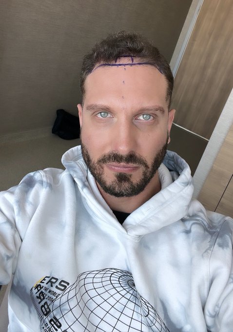 Happy 6 months post op hair transplant! Before to now! Little older, a little grayer but lovely locks<a href="/tag/getmorehair"class="tags"><span>#getmorehair</span></a>