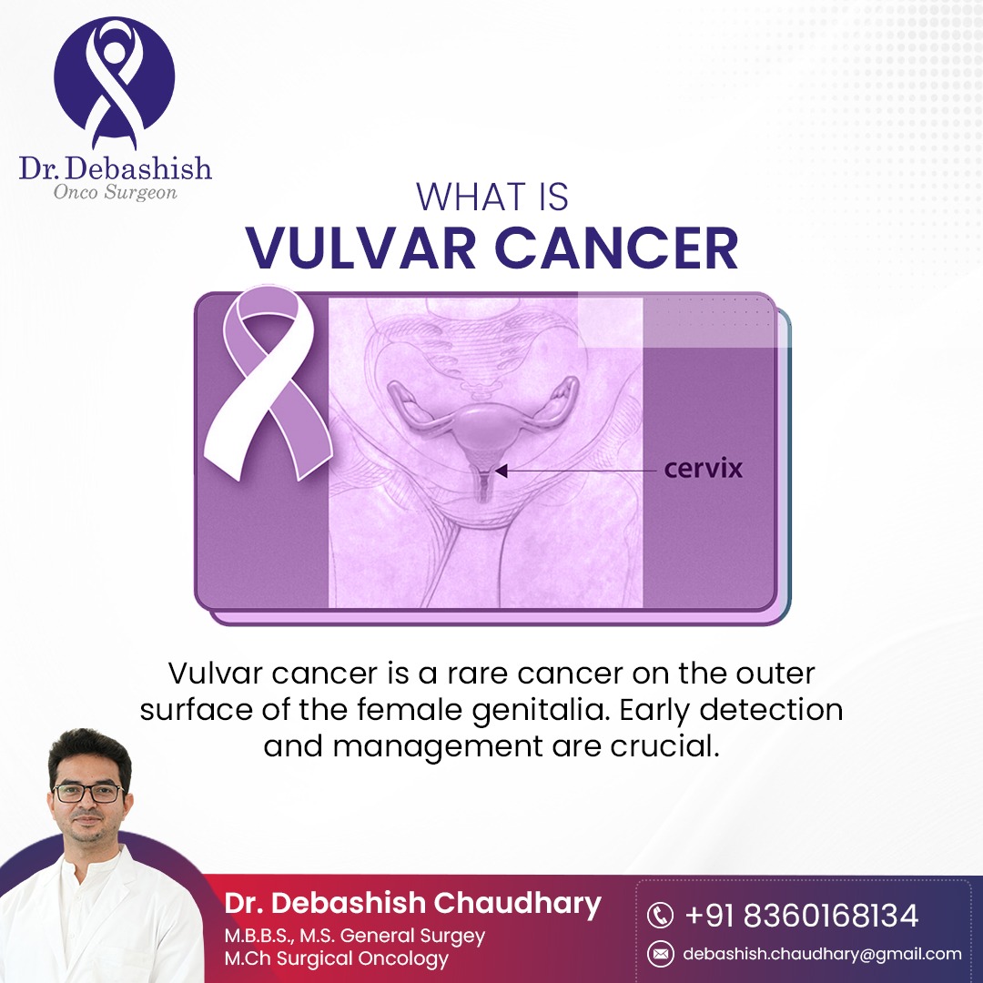 WHAT IS VULVAR CANCER  
Vulvar cancer is a rare cancer on the outer surface of the female genitalia. Early detection and management are crucial. 
Visit - drdebashishoncosurgeon.com/gynecological-…
#vaginalcancer #vulvalcancer #gynaecologicalcancer #cancer #cancerawareness #womenshealth #gynaecancer