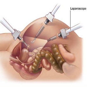 UniversalSurge1's tweet photo. #Laparoscopic Vs Vaginal #Hysterectomy: 5 Benefits Of Getting #Laparoscopic #Surgery 
Read more: https://t.co/H7TGO07ZGH 
share your paper on: https://t.co/7f9IQq9XFt 
#ipjus 
#manuscript 
#reseach 
#Hysterectomy #Surgery https://t.co/GqbQiCWeHw