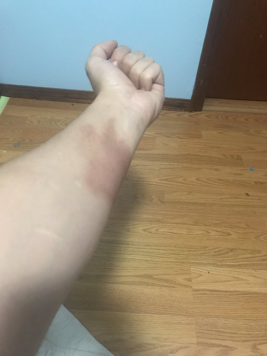 Well my arm looks right fucked 😂

#workplacehazards