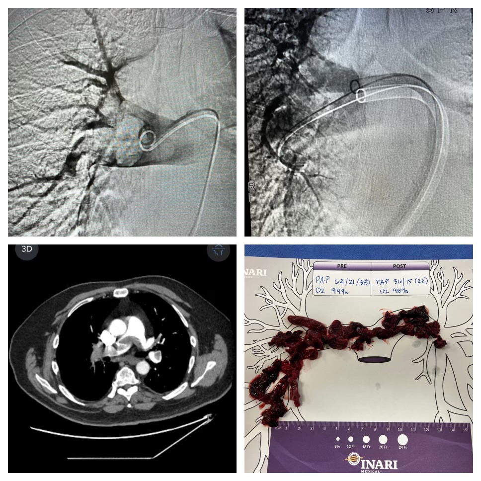 Arun Singh Kahlon, MD, FSCAI tweet media