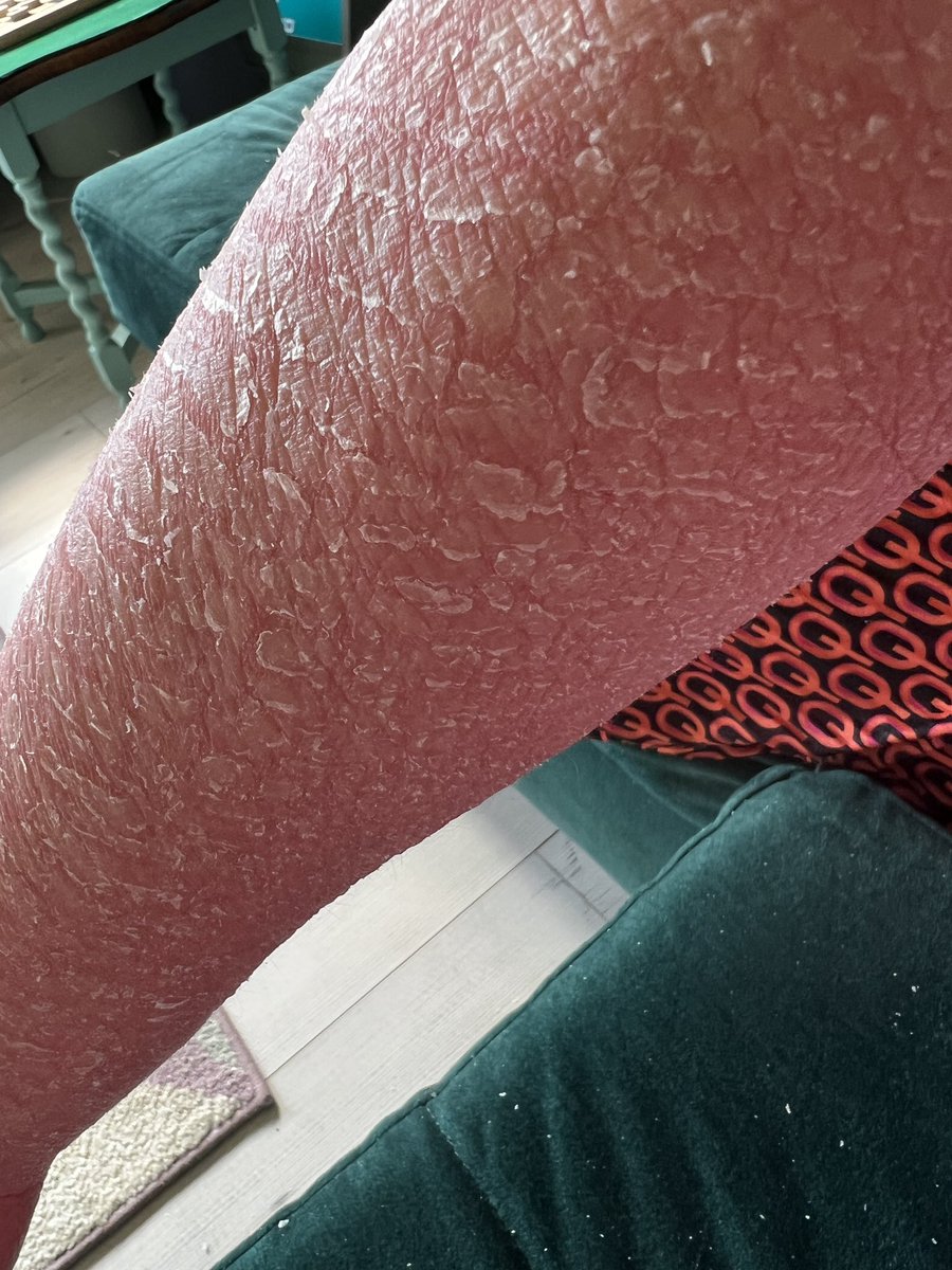 MYTSWWORLD's tweet image. Long oatmeal bath, very soothing. Bag containing oats has come undone, hope it don’t block the bath pipes up. Along with all my shredding skin 👀👀👀👀
#TSW #TopicalSteroidWithdrawal 
#SkinCondition
#RedSkinSyndrome 
#MedTwitter #TSWresearch 
#SkinShredding #dermatology