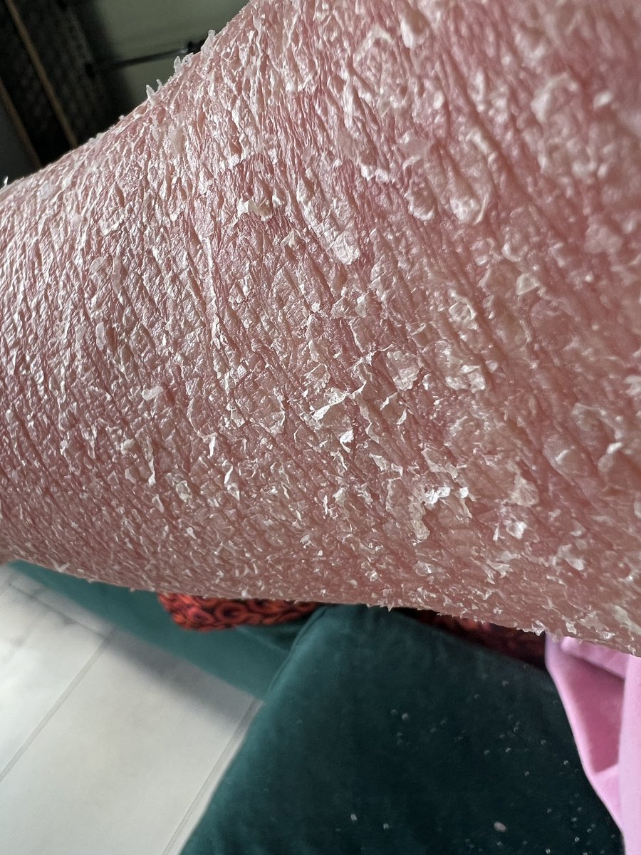 MYTSWWORLD's tweet image. Long oatmeal bath, very soothing. Bag containing oats has come undone, hope it don’t block the bath pipes up. Along with all my shredding skin 👀👀👀👀
#TSW #TopicalSteroidWithdrawal 
#SkinCondition
#RedSkinSyndrome 
#MedTwitter #TSWresearch 
#SkinShredding #dermatology