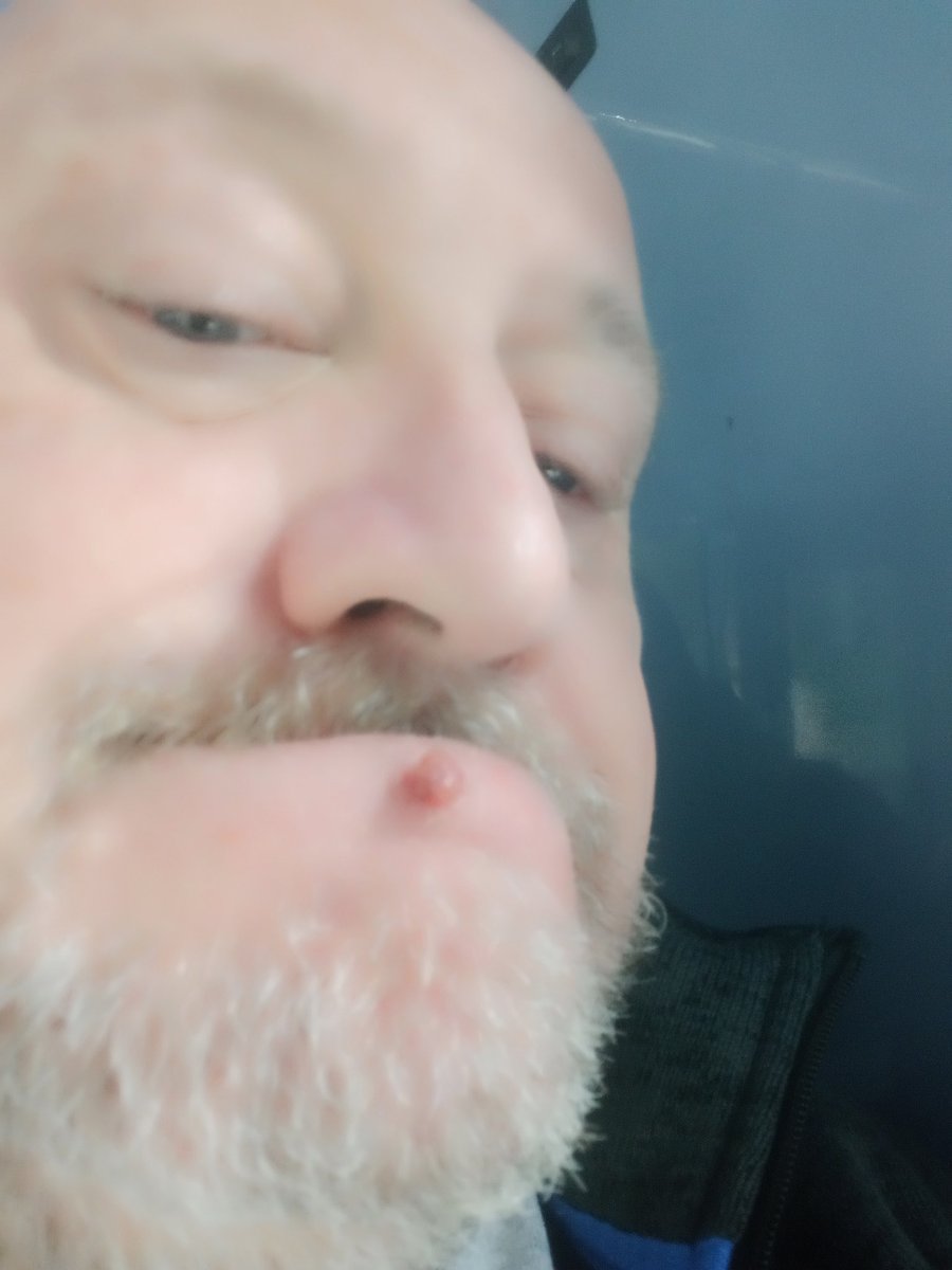 andyangel44's tweet photo. Off to Dermatology Out Patients for a 'minor surgical procedure' (removal and testing of my face grape -pic 1).
On the+ side, my copy of @AndiEwington's #TheHeroInterviews has arrived. It's a lot bigger than I expected (#AsTheActressSaidToTheBishop) but lots of fun #ILikeBigBooks https://t.co/k1Z4moUuEL