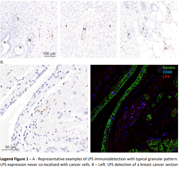 NFdeMiranda's tweet photo. π¬In a bid to replicate a prior study, we couldn't confirm LPS presence within breast cancer cells. We did spot it around ducts & in macrophages, aligning with its biology.
#ResearchReplication #Cancer #Microbiome
https://t.co/oEeMunnSIB https://t.co/tjLw7OX0oT
