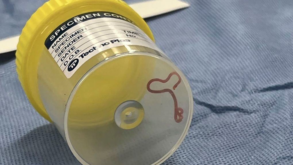 CTVNews's tweet photo. Neurosurgeon pulls live worm from brain of Australian woman hospitalized with 'mystery illness' https://t.co/eTdDIRi1Np https://t.co/Ln0FpoSyGa