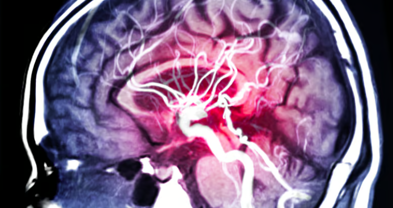 Traditionally, #aneurysms have been treated with surgery, but some are too hard to access safely. That could be changing though, as a new study found a potential alternative treatment – the cancer drug #sunitinib

hubs.li/Q01WZ53h0

#brainaneurysms #neurology #neurosurgery