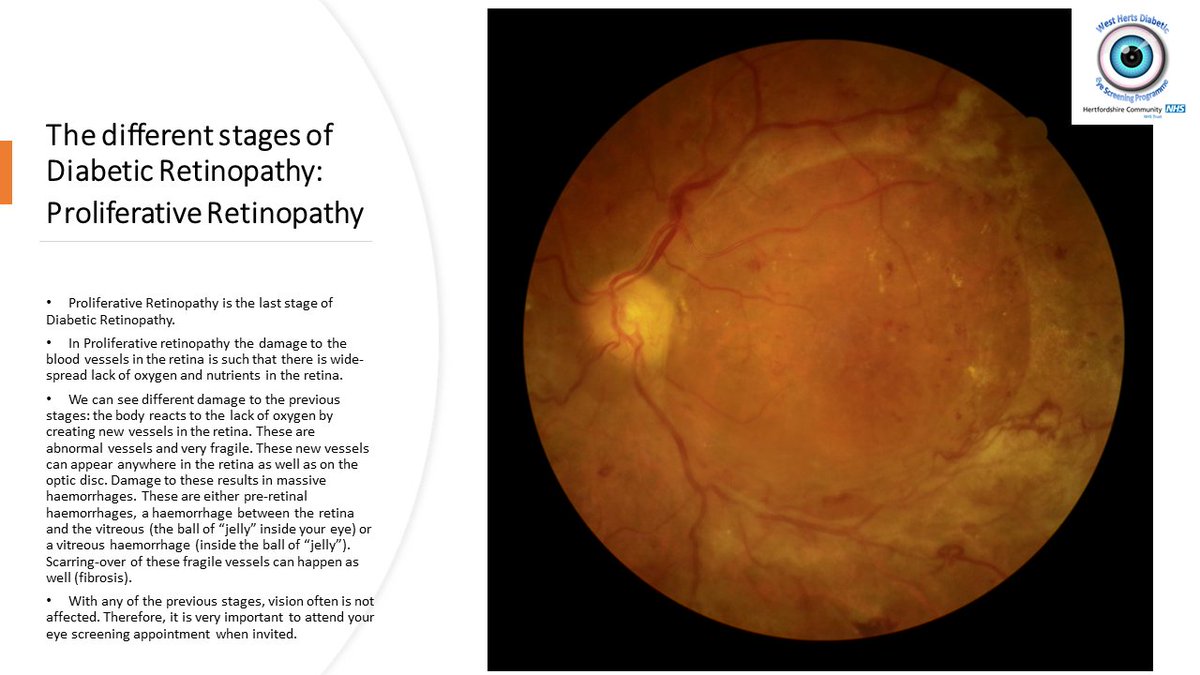 Herts and W-Essex Diabetic Eye Screening Service tweet media
