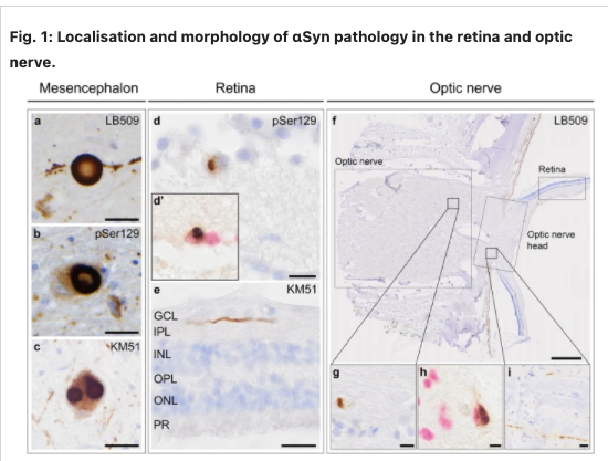 MichaelOkun's tweet photo. Do you know the story these '99' eyes told us about parkinsonism? Can you believe these scientists collected '99' post-mortem eyes which revealed something interesting with  α-synuclein. We think about dopamine retinal amacrine cells and thinning of the retina however check out these results.
'Multiple retinal and optic nerve cross-sections were immunostained with anti-α-synuclein antibodies.' α-Synuclein seen as Lewy neurites in retina and oligodendroglial cytoplasmic inclusions in the optic nerve. 
100% of multiple system atrophy cases, optic nerve had oligodendroglial cytoplasmic inclusions, and retinal Lewy neurites were absent in these cases. https://t.co/xPB30pxuzj