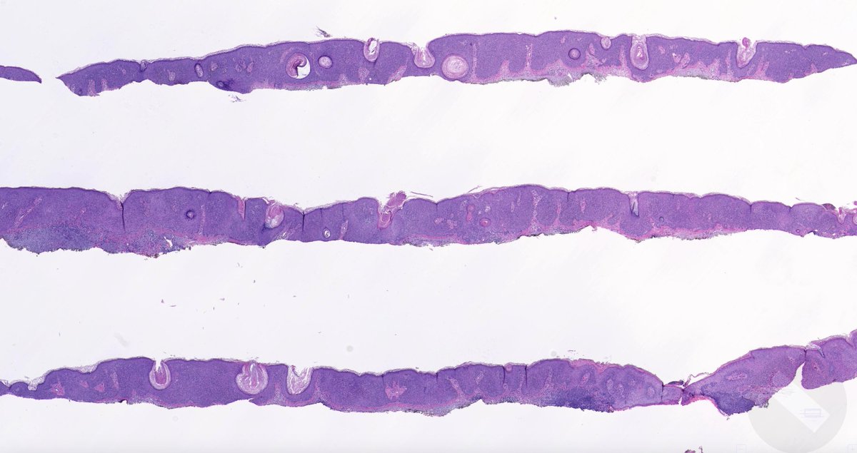 What is your diagnosis? (hint: might be more than one!) WSI digital slide & Answer: kikoxp.com/posts/4590 More posts from Dr. @VKazlouskaya kikoxp.com/viktoryia_kazl… #medTwitter #pathology #pathologists #pathTwitter #dermpath #dermatology #dermtwitter