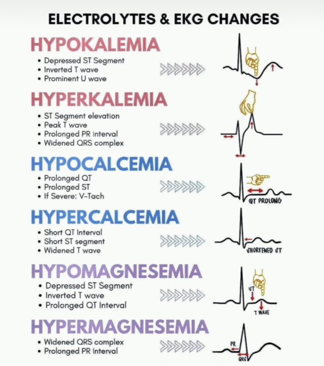 DrPharmDMDTh's tweet photo. Electrolytes and EKG changes https://t.co/fMCSnY9GiF