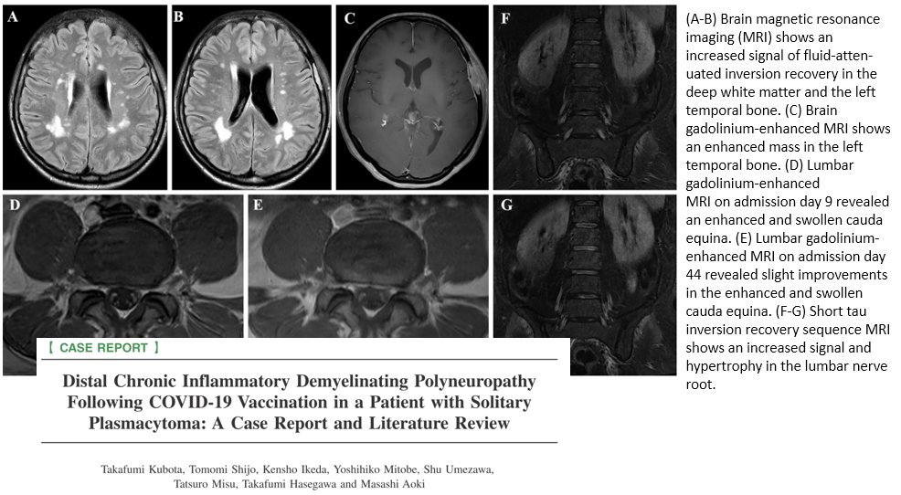 DrJohnB2's tweet photo. "Physicians should be aware of distal chronic inflammatory demyelinating polyneuropathy  as a rare complication of COVID-19 vaccination."
https://t.co/v8RyNPRt1Y

"Two months after the onset, she became unable to walk ..." https://t.co/wc3mhppxWr
