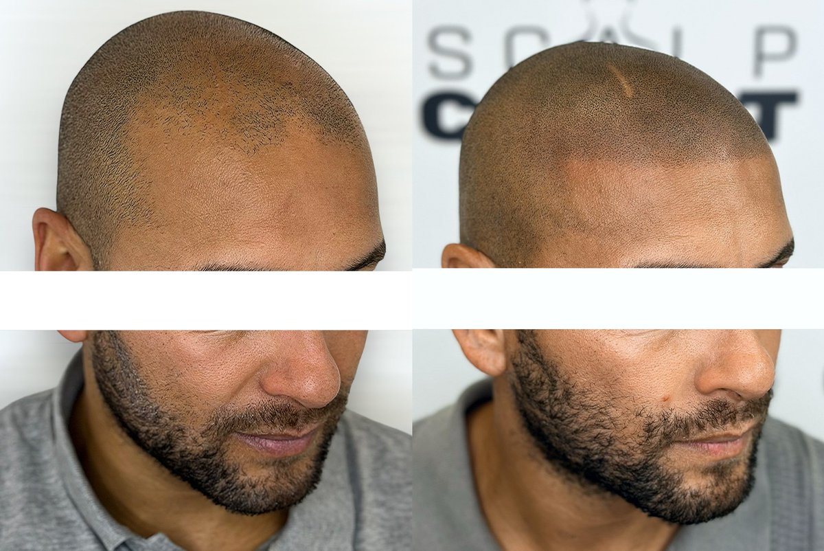 SCALPCRAFT's tweet image. Nearly 80% of men suffer from hair loss in the UK, that’s a huge stat. 

Hair loss can happen for a multitude of reasons such as genetics, stress, illness and alopecia. 

It can be highly distressing for some. 

Many who suffer from hair loss want a solution, but too many of them…