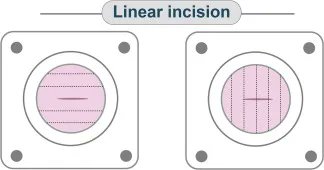 EurUrolOpen's tweet image. Assessment of Urostomy Parastomal Herniation Forces Using Incisional Prevention Strategies with an Abdominal Fascia Model 

buff.ly/3OQxAXE 

@KDibo900 @yashusxdcr @schadegr 

#UroSoMe #Openaccess #Openscience