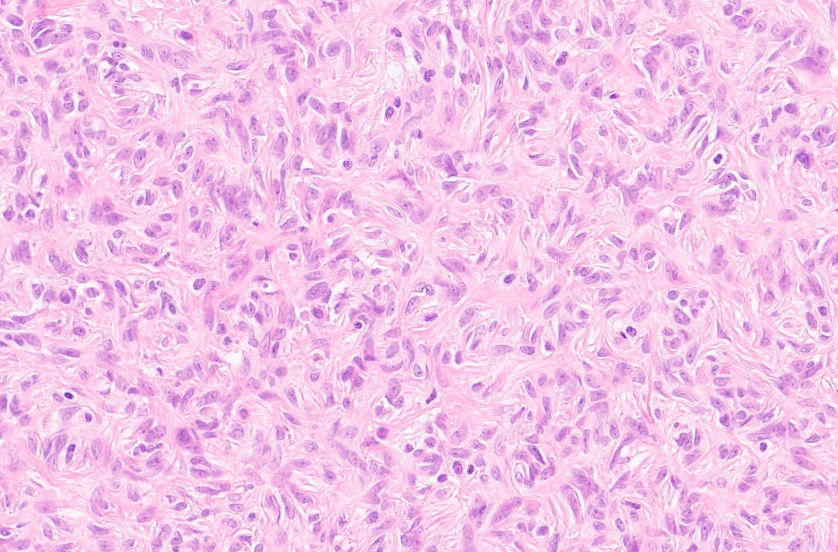 KiKo (@kiko4docs) on Twitter photo Skin lesion on the leg. F:49-year-old. What is your Dx?
More pics & Answer: kikoxp.com/posts/15833
More posts from Dr. Rey <a href="/ReyPathology/">Severino Rey MD, PhD</a> kikoxp.com/severino_rey1
#medTwitter #pathology #pathologists #pathTwitter #dermpath #dermatology #dermatologia #dermtwitter Skin lesion on the leg. F:49-year-old. What is your Dx?
More pics & Answer: kikoxp.com/posts/15833
More posts from Dr. Rey <a href="/ReyPathology/">Severino Rey MD, PhD</a> kikoxp.com/severino_rey1
#medTwitter #pathology #pathologists #pathTwitter #dermpath #dermatology #dermatologia #dermtwitter