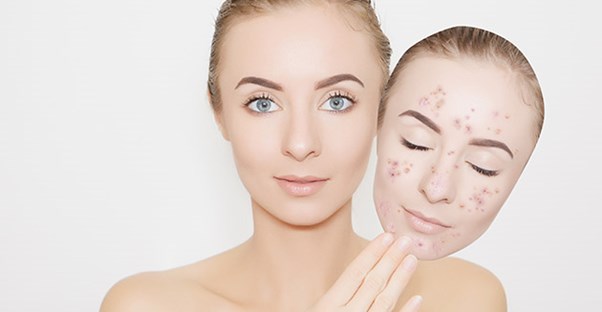 AlotHealth's tweet photo. Experiencing acne problems even after puberty? You're not alone. Here are 20 home remedies to get rid of adult acne once and for all!  #skincare #acnetreatment #adultacne 

https://t.co/UEHh9mKVbP https://t.co/brixfA8uMY