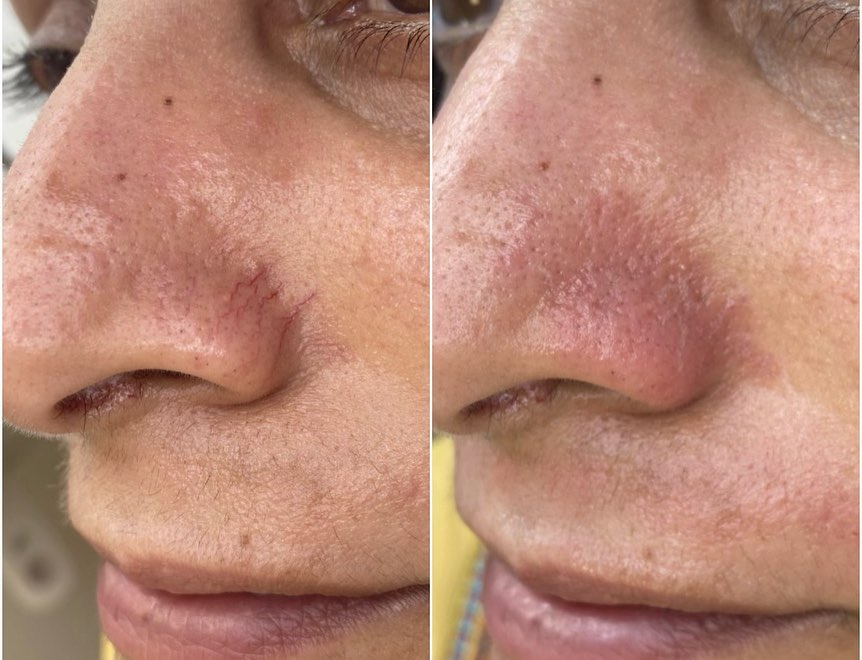 foreverbyash's tweet photo. Our process involves using a microneedling device to roll over and penetrate the top layer of skin with fine needles. Learn more about our services by visiting our website today!

#Microneedling https://t.co/PRkx7sa82r https://t.co/67izABdnIk