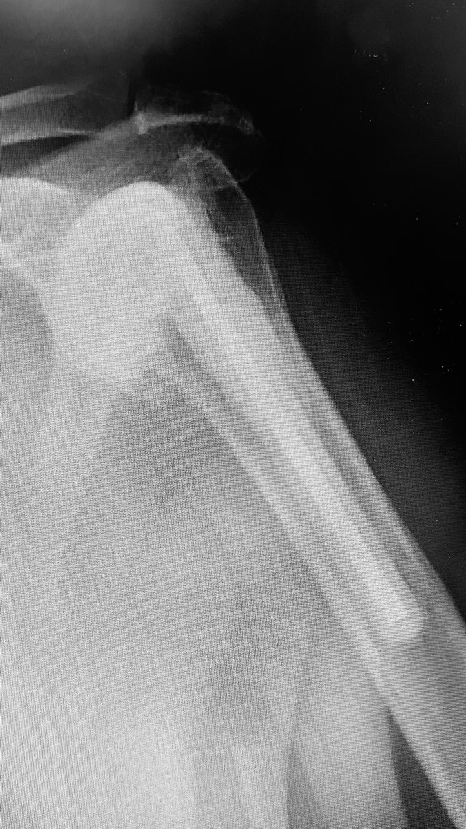 Cement spacer Inserted for osteomyelitis of the humeral head 10 yrs ago . Lost to follow up for 2nd stage until today. No pain and reasonable ROM.