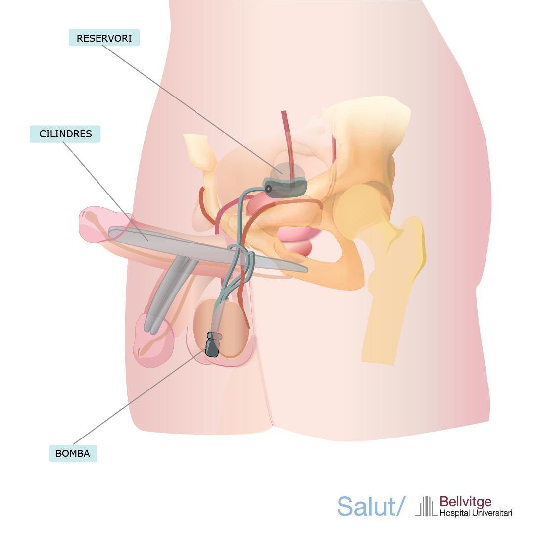 hbellvitge's tweet photo. #ElMeuQuirofan | Com es realitza la cirurgia de pròtesi de penis al nostre hospital? Quins tipus d'implants es poden aplicar?
ℹ️ Descobreix tots els detalls a: https://t.co/QmlMDZ74E1
#protesipenis #protesispene https://t.co/PWaOgehV9N