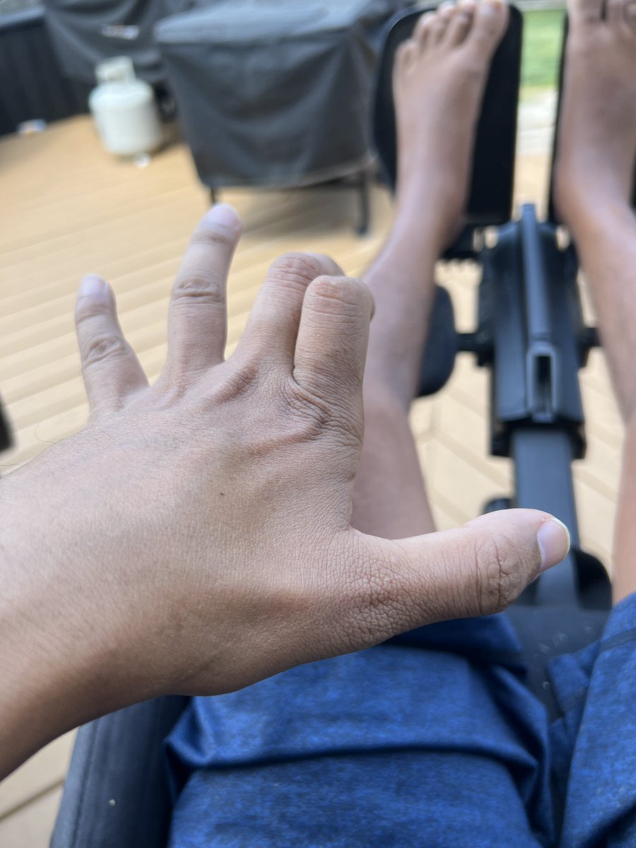 mauricioj2001's tweet photo. #ALS is shutting down my body, maybe #Nurown will help me slow down my progression @US_FDA please don’t deny me access https://t.co/WBSTuE664C