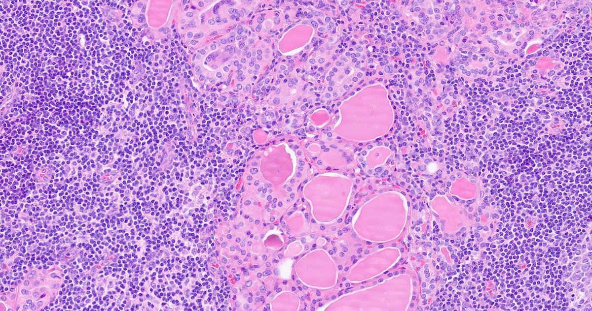 WillyFogPath's tweet image. Tiroiditis de Hashimoto👀
🔸️Enfermedad autoinmune con ⬆️Ac antiperoxidasa y antitiroglobulina en 🩸.
🔸️+común en ♀️edad media.
🔸️Clínica de hipotiroidismo.
🔸️Macro: ⬆️tamaño tiroides (2-3×), irregular.
🔸️🔬:infiltrado linfoplasmocitario+ folículos atróficos.
#EndoPath