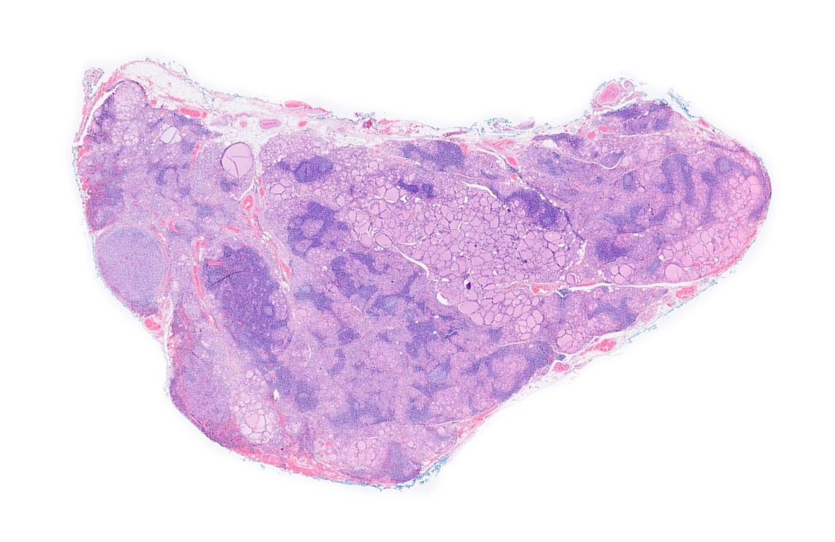 WillyFogPath's tweet image. Tiroiditis de Hashimoto👀
🔸️Enfermedad autoinmune con ⬆️Ac antiperoxidasa y antitiroglobulina en 🩸.
🔸️+común en ♀️edad media.
🔸️Clínica de hipotiroidismo.
🔸️Macro: ⬆️tamaño tiroides (2-3×), irregular.
🔸️🔬:infiltrado linfoplasmocitario+ folículos atróficos.
#EndoPath