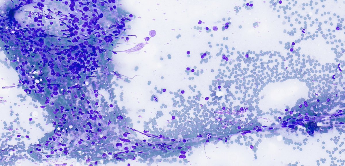 WillyFogPath's tweet image. Tiroiditis de Hashimoto👀
🔸️Enfermedad autoinmune con ⬆️Ac antiperoxidasa y antitiroglobulina en 🩸.
🔸️+común en ♀️edad media.
🔸️Clínica de hipotiroidismo.
🔸️Macro: ⬆️tamaño tiroides (2-3×), irregular.
🔸️🔬:infiltrado linfoplasmocitario+ folículos atróficos.
#EndoPath