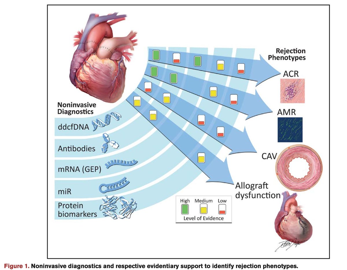 Jason F. Goldberg MD MS (@jasongoldbergmd) on Twitter photo #Tweetorial (1 of 6) dd-cfDNA has significant evidence in diagnosing ACR and AMR. GEP can diagnose ACR only, and HLA antibodies are associated with AMR. More data needed for MicroRNA and Proteomics and in CAV. <a href="/PalakShahMD/">Palak Shah</a> <a href="/laurentrubymd/">Lauren K. Truby</a> <a href="/Annette_HLA/">Annette Jackson</a> <a href="/KiranKhush1/">Kiran Khush</a> <a href="/AgborOmicsLab/">Dr. Agbor-Enoh Omics Lab</a> #Tweetorial (1 of 6) dd-cfDNA has significant evidence in diagnosing ACR and AMR. GEP can diagnose ACR only, and HLA antibodies are associated with AMR. More data needed for MicroRNA and Proteomics and in CAV. <a href="/PalakShahMD/">Palak Shah</a> <a href="/laurentrubymd/">Lauren K. Truby</a> <a href="/Annette_HLA/">Annette Jackson</a> <a href="/KiranKhush1/">Kiran Khush</a> <a href="/AgborOmicsLab/">Dr. Agbor-Enoh Omics Lab</a>