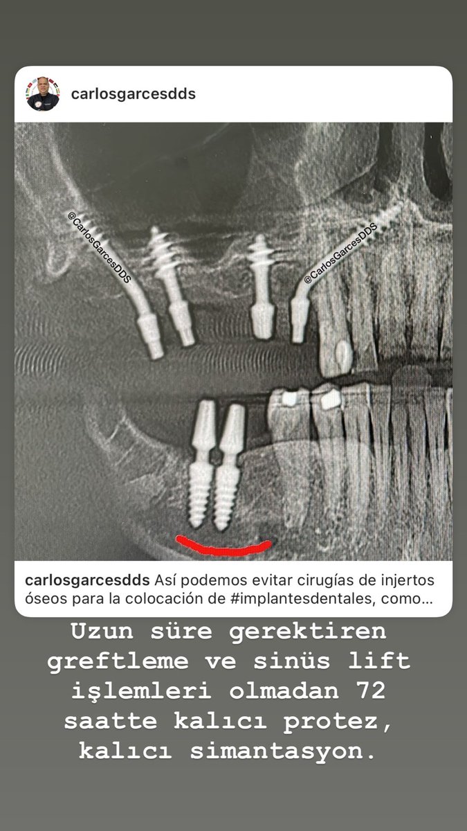 Kemik genişletme ve augmentasyona ihtiyaç duymadan implant uygulamak tabikide mümkün.