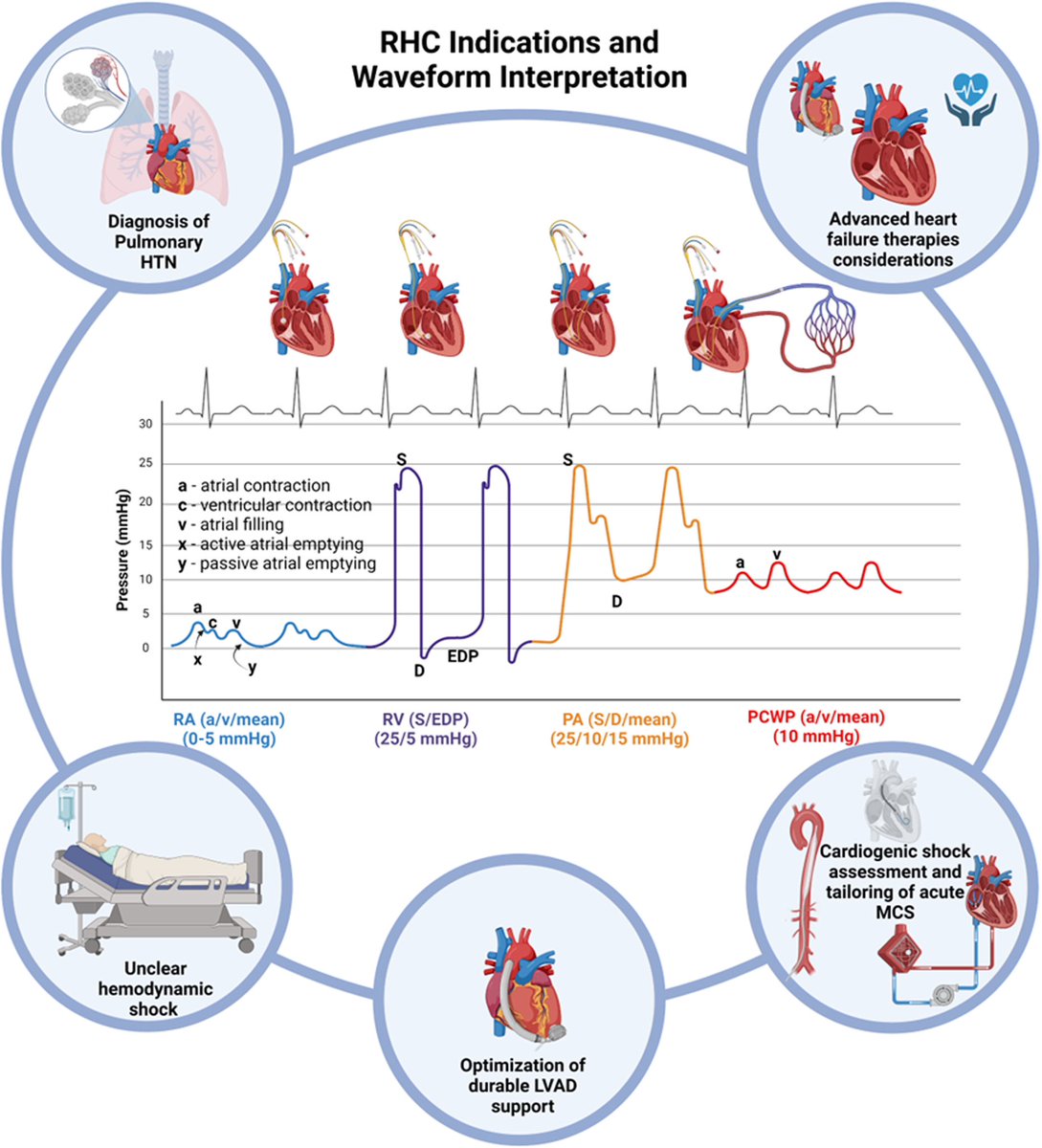 How well you know RHC? @YevgeniyBr @fischman_david write the educational case series #JACCCaseReports on Right Heart Catheterisation ➡️ jacc.org/doi/10.1016/j.… @JACCJournals @EstefaniaOS @EZancanaroMD @ABeneduceMD @MinnowWalsh @argulian @sarano_maurice @ACCinTouch