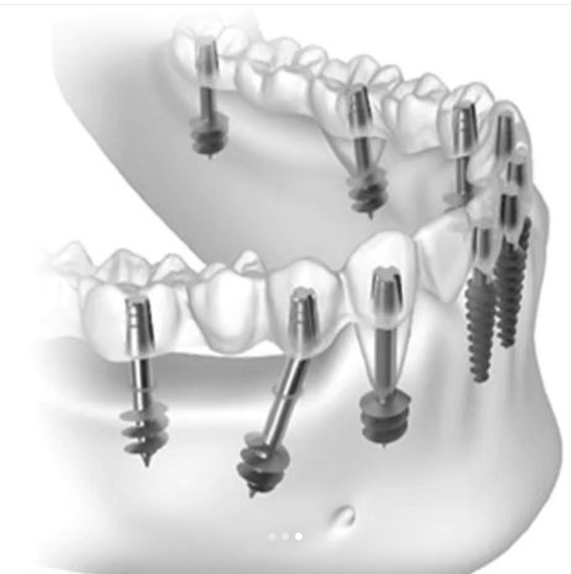 Endikasyona uygun implant seçenekleri
