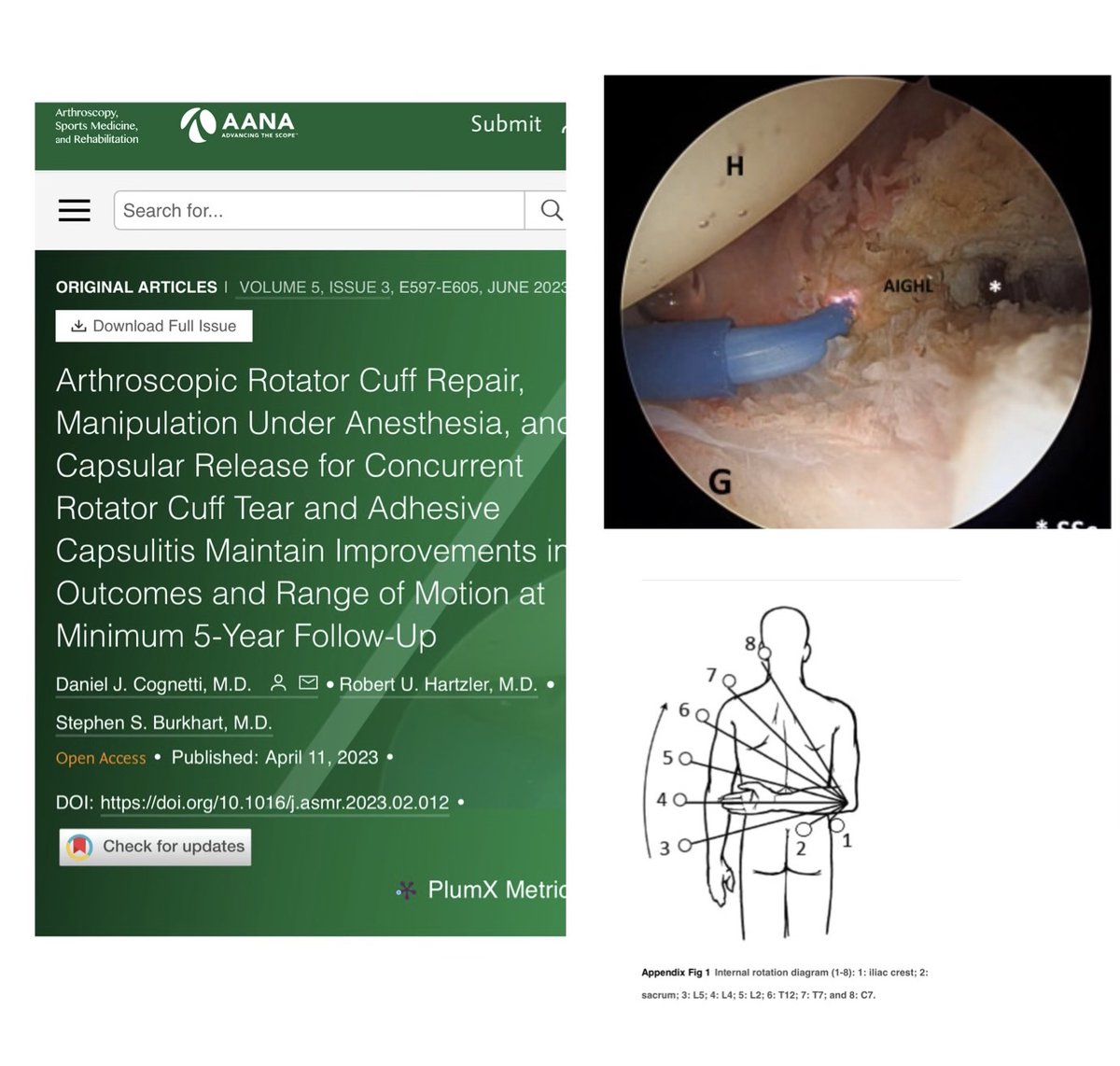 Should we manipulate and repair at the same time??? Arthroscopic Rotator Cuff Repair, Manipulation Under Anesthesia, and Capsular Release for Concurrent Rotator Cuff Tear and Adhesive Capsulitis Maintain Improvements in Outcomes and Range of Motion at Minimum 5-Year Follow-Up