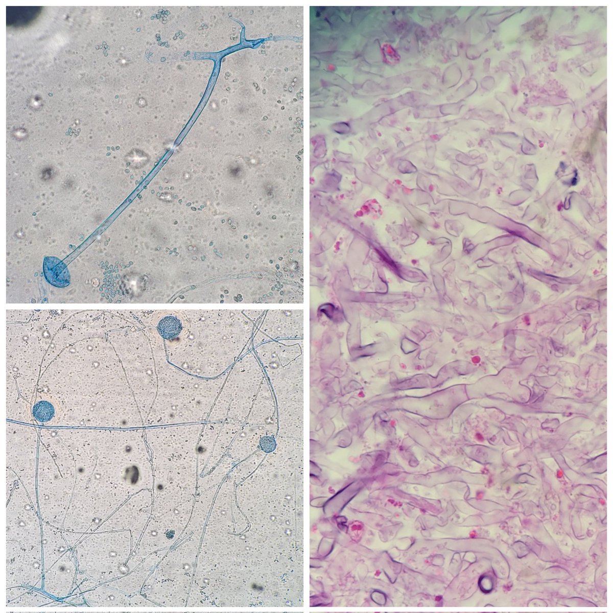 Often, Mucorales fungi are called aseptate. But in reality, they are pauciseptate, which means they do have septations, but its just rare. You can see a perfect example of this in this lung biopsy (pic on R) and the LPCB tape preps (pics on L).