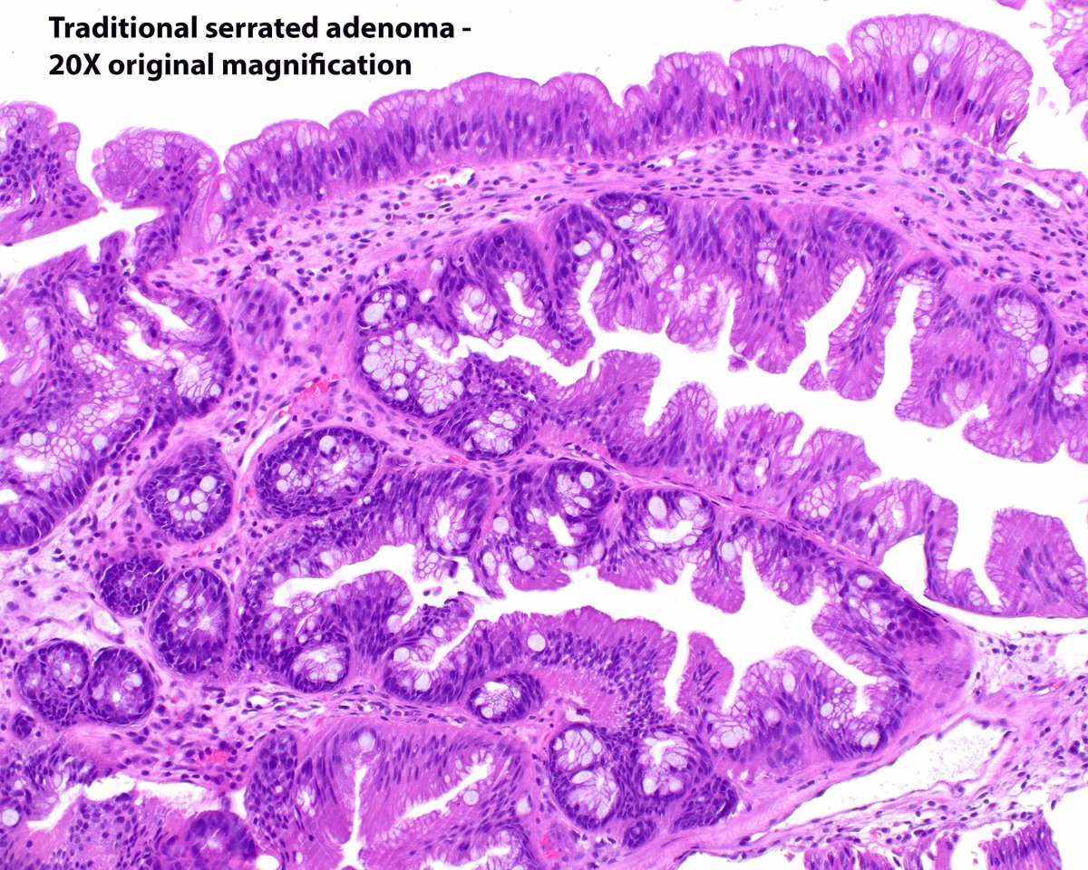 Traditional serrated adenoma (TSA) and tubular adenoma (TA) in the same biopsy cup. The nuclei in the TSA are much smaller and paler than those in the TA, even in the proliferation zones (the ectopic crypt formations).