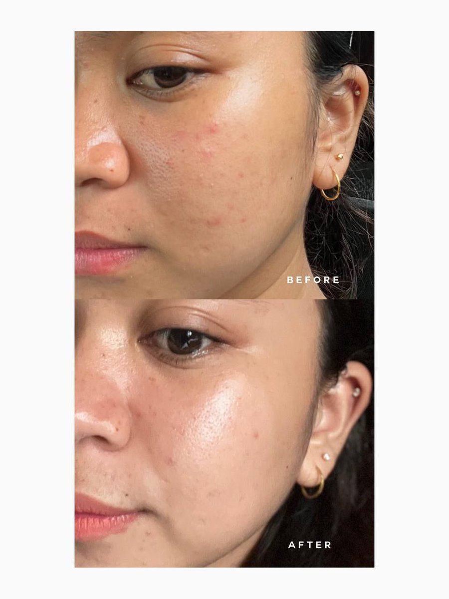 ethereallydaisy's tweet photo. The results The feedback
I tak tipu tau bila cakap kita punya #TehBunga cleanser ni akan buat skin you flawless and glowing!Tak percaya tengok feedbacks bawah ni✨
Yang penting kena consistent je, baru boleh nampak results💗 https://t.co/JHj4lqJacG