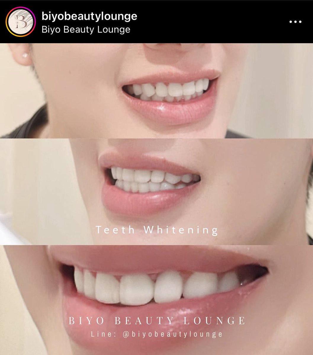 BiyoLounge's tweet image. そろそろ歯のお手入れしませんか？
歯が汚い状態は、口臭や歯周病などの口内トラブルの原因となることがあります。また、歯の着色や黄ばみが目立つことで笑顔の美しさが損なわれる可能性もあります。歯の健康と美しさを保つためには適切なケアが必要です。
#シラチャ #ホワイトニング #歯の健康