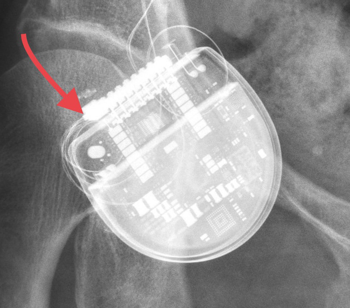 GeorgiosMatis's tweet photo. 🔹Female, 63yrs, back- &amp; leg pain since 2012, #FBSS (#PSPS Type II)
🔹2013: 1 lead with 8 contacts &amp; Prodigy
🔹2016: 1 more lead with 8 contacts to cover the back - pain relief of 70%
🔹05/2023: EOS, check of impedances preoperatively not possible 👉🏼 replacement of #IPG

1/n https://t.co/VhxXUyACCH