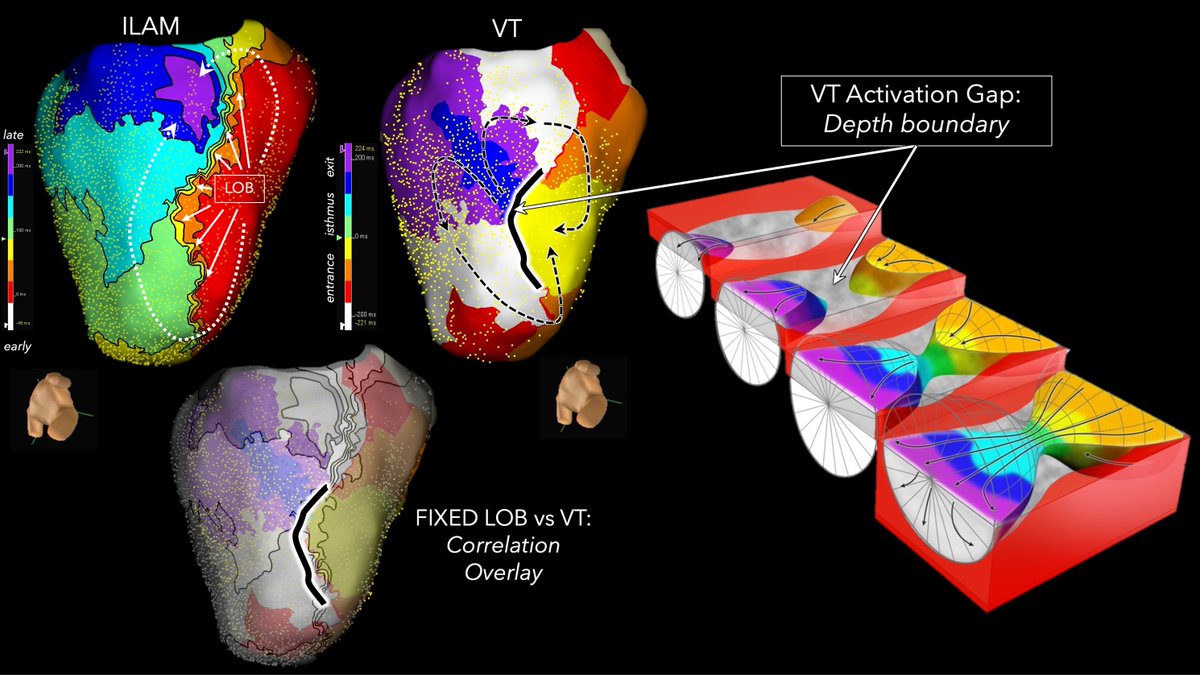 Our first paper @CircAHA from Phoenix is a huge milestone! This collective passion piece is likely our final installment of #ILAM x #VTin3D as it ties together both concepts and re-defines lines of block as fixed barriers in human VT: 1.) Deceleration zones are due to localized…