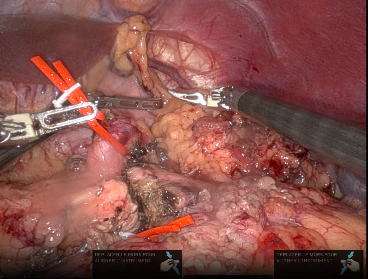 EmmanuelMelloul's tweet photo. CHUV HPB team: Robotic splenopancreatectomy for Insulinoma of the tail of the pancreas. @CHUVLausanne @VisceralChuv @IHPBA @EAHPBA @ProfDemartines @dr_memeor https://t.co/5abdfUuKpq