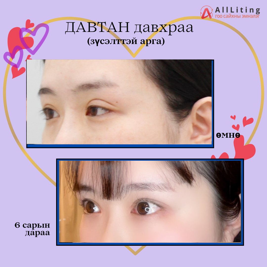 💟#ДАВТАН #ДАВХРАА 💟 #үр_дүнгийн_зураг

хийлгэсэн мэс ажилбар
❣️ДАВТАН давхраа #6сарын_дараа
-------------------------------
📍📍 ҮЗЛЭГ/ЗӨВЛӨГӨӨ үнэгүй хийж зөвхөн таньд тохирсон мэс заслын төлөвлөгөөг гаргана.
☎️монгол ажилтан: 010-4931-4451