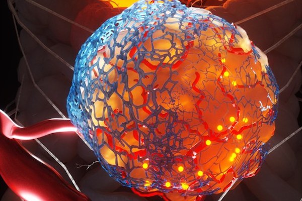 Metastasis Research Society (@metastasisrs) on Twitter photo New findings just published in <a href="/NatureCancer/">Nature Cancer</a> from <a href="/thomasrcox/">Thomas R. Cox</a> & colleagues from <a href="/GarvanInstitute/">Garvan Institute of Medical Research</a> reveal a new Australian drug that targets scar-like ‘fibrotic’ tissue within tumours shows promise for treating pancreatic ductal adenocarcinoma. garvan.org.au/news-events/ne… New findings just published in <a href="/NatureCancer/">Nature Cancer</a> from <a href="/thomasrcox/">Thomas R. Cox</a> & colleagues from <a href="/GarvanInstitute/">Garvan Institute of Medical Research</a> reveal a new Australian drug that targets scar-like ‘fibrotic’ tissue within tumours shows promise for treating pancreatic ductal adenocarcinoma. garvan.org.au/news-events/ne…
