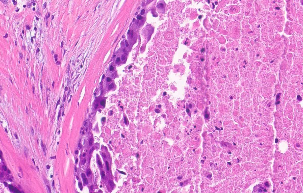 What is that? Answer: kikoxp.com/posts/15048 More posts from Dr. Rey @ReyPathology kikoxp.com/severino_rey1 #pathology #pathTwitter #medTwitter