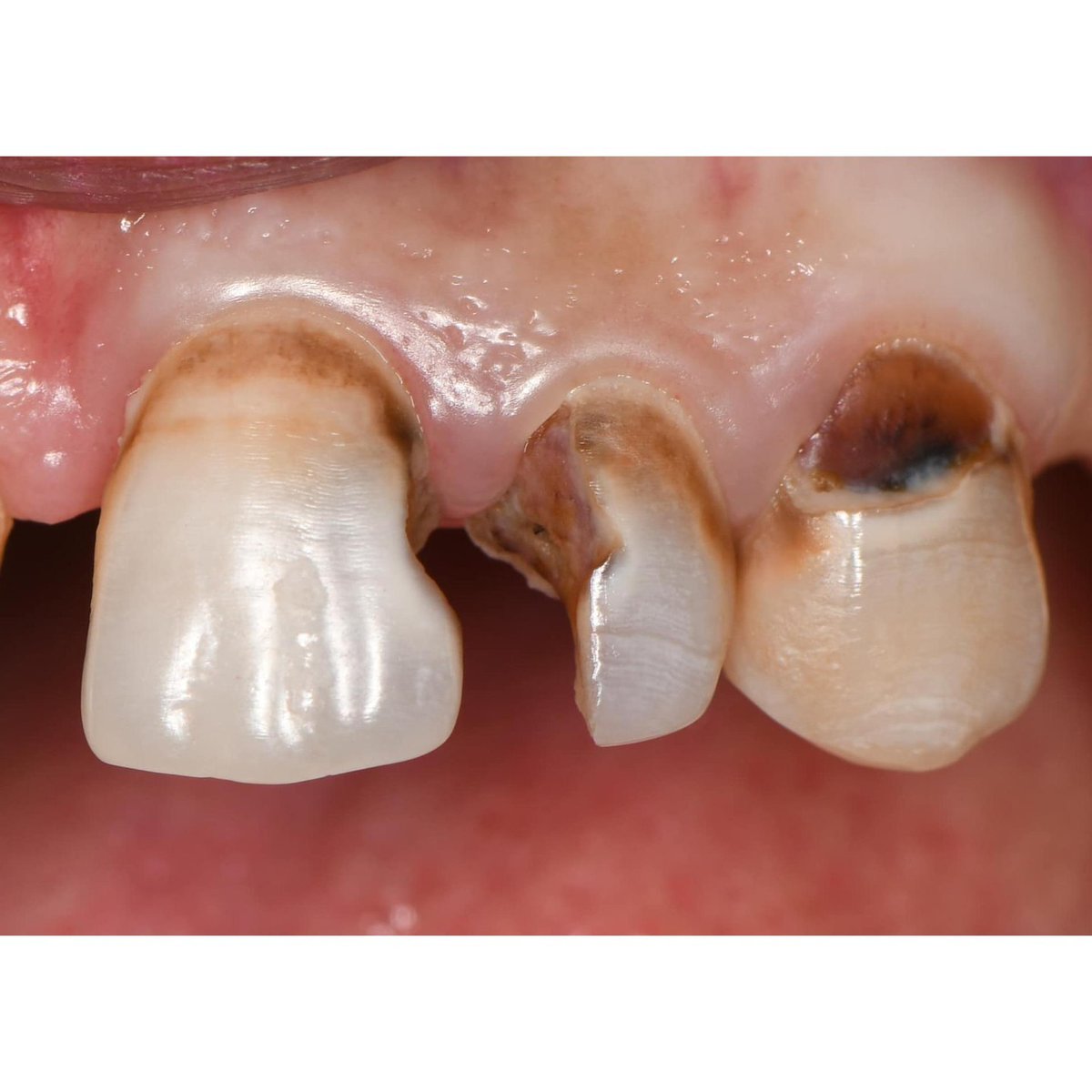 Dentagama's tweet photo. Direct composite restoration https://t.co/rFuH2Dz8fz
