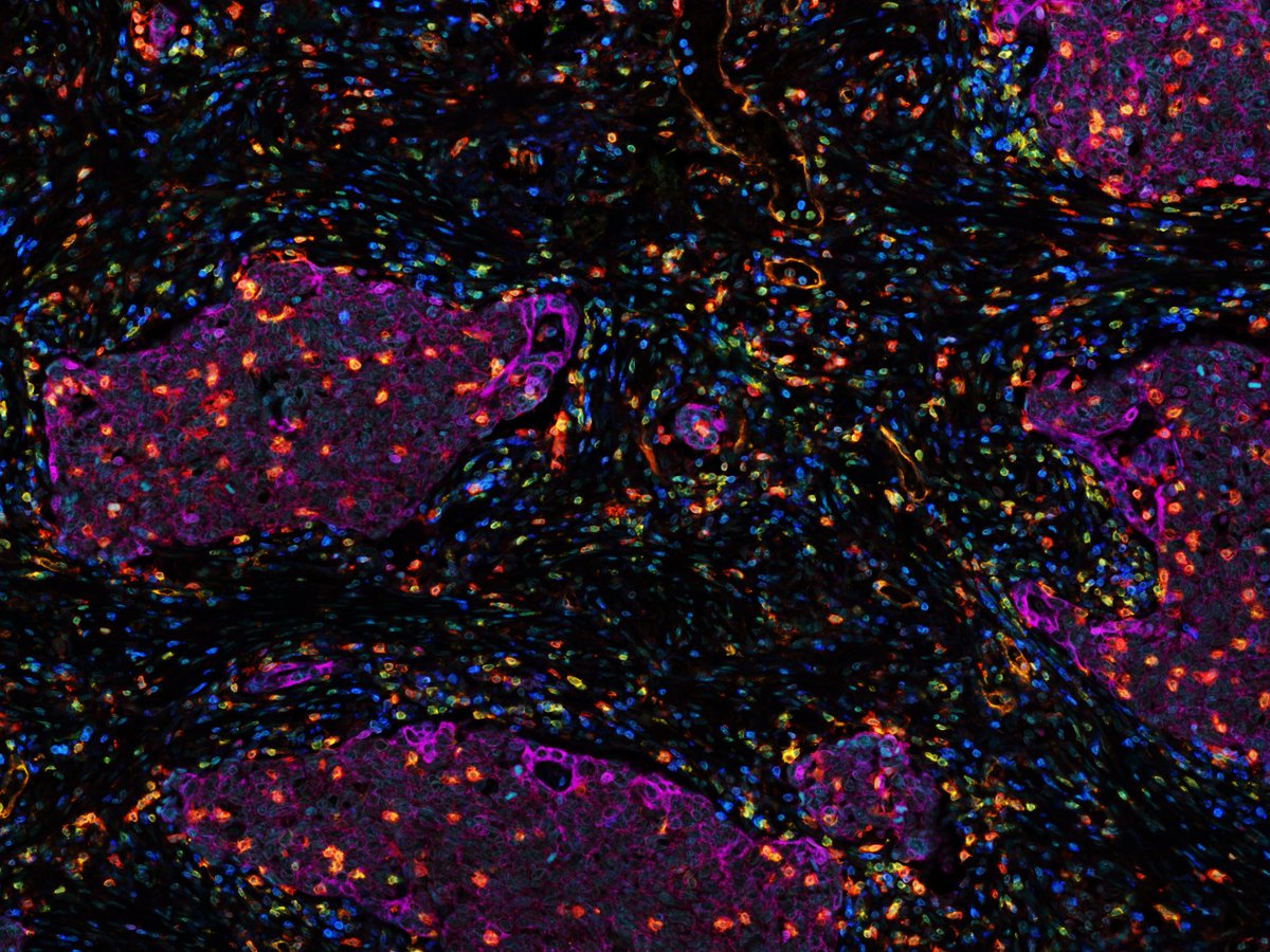 I especially love this image where the tumour nest (purple) infiltrating T cells appear on fire 🔥.