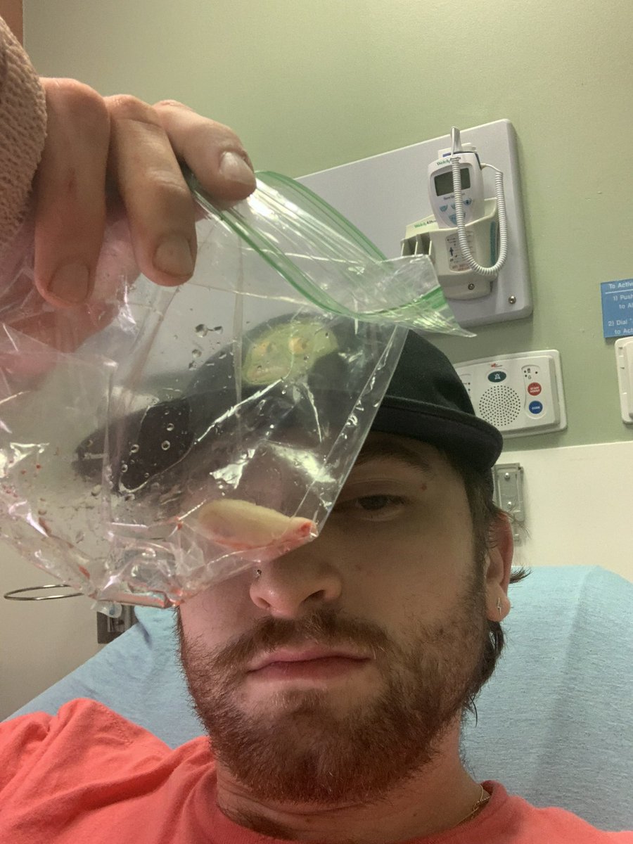 sadskateboy's tweet photo. it has officially been one year since i’ve lost my pinky :,-) https://t.co/0KB2Rn5ZzX
