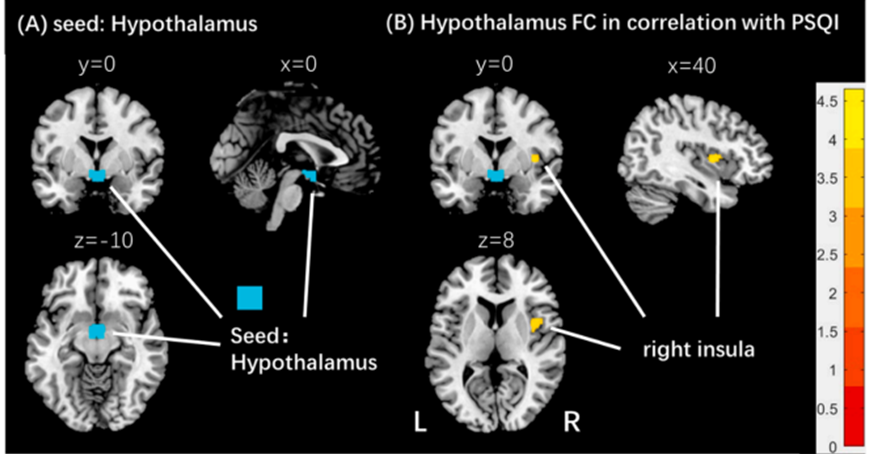 Brain_VTA's tweet image. 📢NEWS
‼️Prof. Lin Yang’s and Dongmei Hao’s team discovered the sleep dysfunction is associated with negative emotions and #hypothalamic #rsFC with the right #insula, a core structure of the interoceptive circuits.
doi.org/10.1016/j.neur…