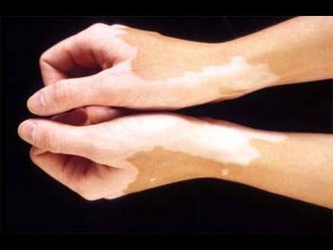 al_chemist607's tweet image. Drinking Milk 🥛 after Eating Fish 🐠 cause this disease....??
Can any one guide in this aspect???
Is this reality or a Myth???
#FishCreek
#HealthTips
#REALITY